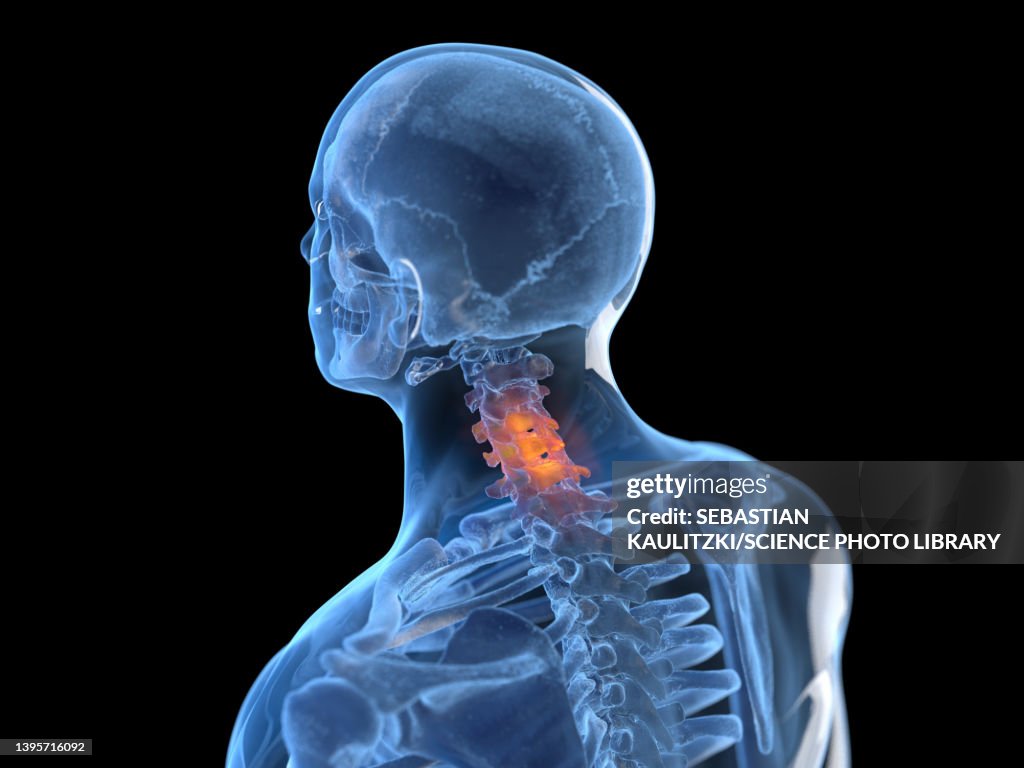 Inflamed Neck Illustration High-Res Vector Graphic - Getty Images