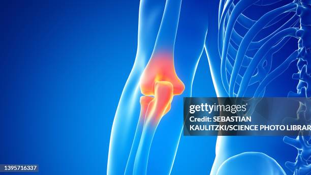 ilustrações de stock, clip art, desenhos animados e ícones de painful elbow joint, illustration - úmero