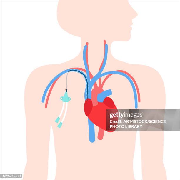 central venous catheter, illustration - surgical equipment stock illustrations stock-grafiken, -clipart, -cartoons und -symbole