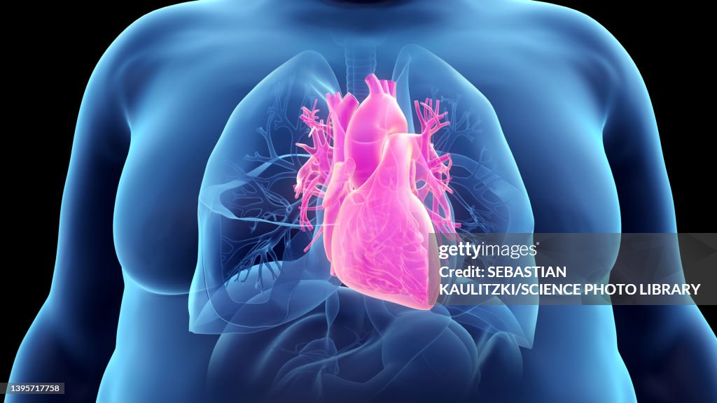 Obese man's heart, illustration