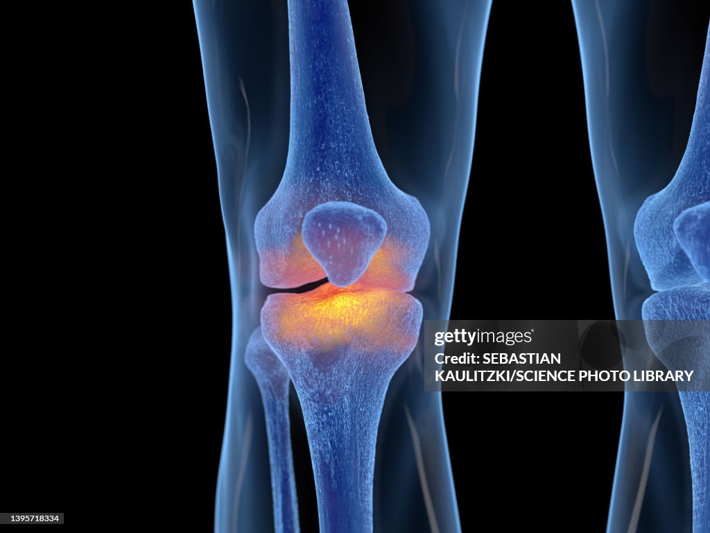 Inflamed Knee Joint Illustration High-Res Vector Graphic - Getty Images