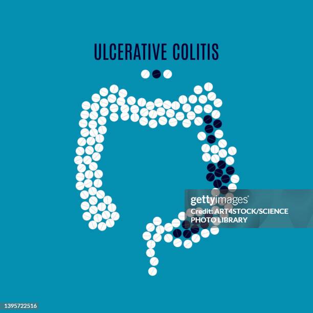 Ulcerative Colitis Gi Ulcerative Colitis Photos and Premium High Res Pictures - Getty Images