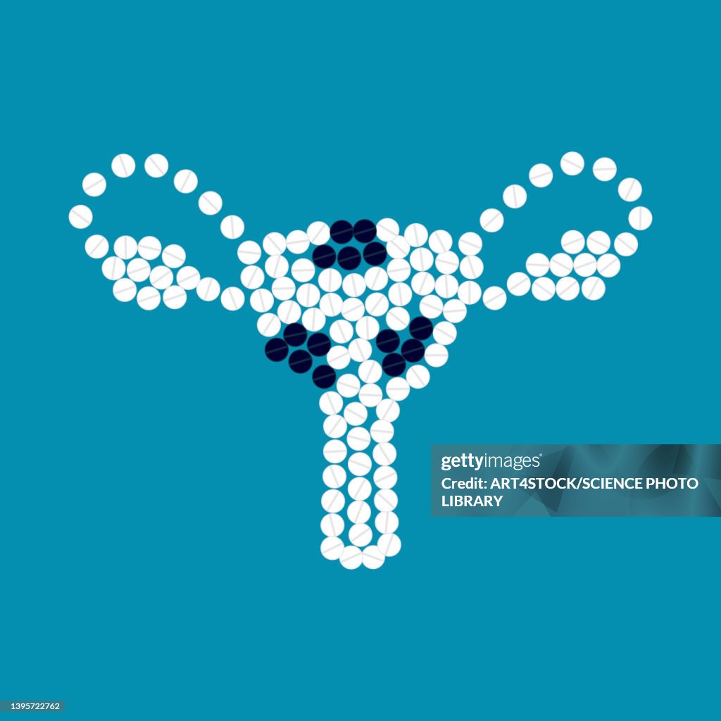 Uterine fibroids, conceptual illustration