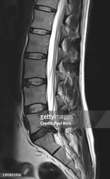 magnetic resonance image - vertebrae of spine with one herniated disc that presses on the spinal cord - herniated disc fotografías e imágenes de stock