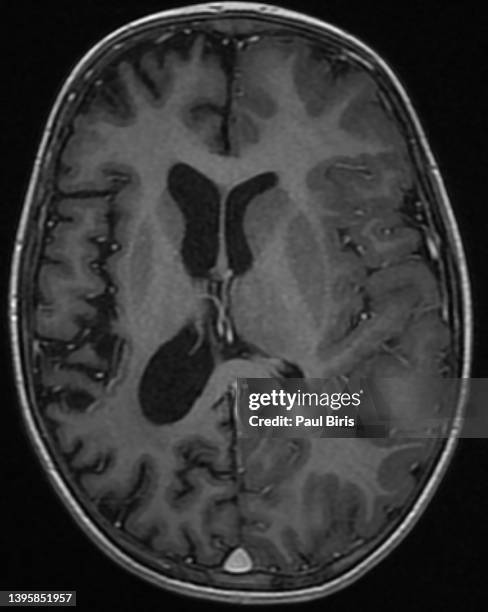 cerebral hemiatrophy seen on mri t1 postgadolinium injection axial view - atrophy stock pictures, royalty-free photos & images