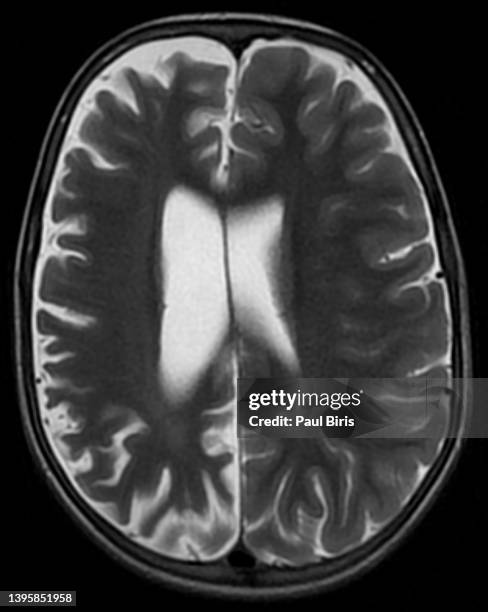 cerebral hemiatrophy seen on mri t2 axial brain image - atrophy stock pictures, royalty-free photos & images