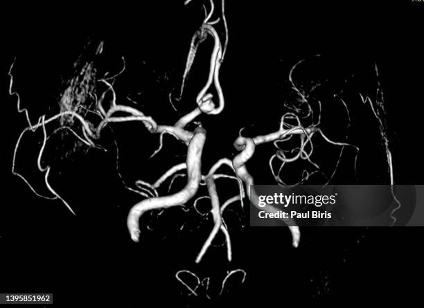 incidental saccular aneurysms on head mr angiography, anterior communicating artery aneurysms - human artery foto e immagini stock