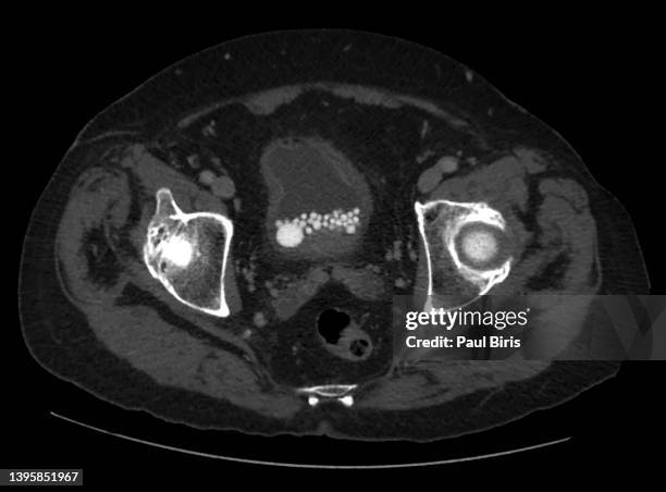 urinary bladder stones seen on axial ct scan - cystitis stock pictures, royalty-free photos & images