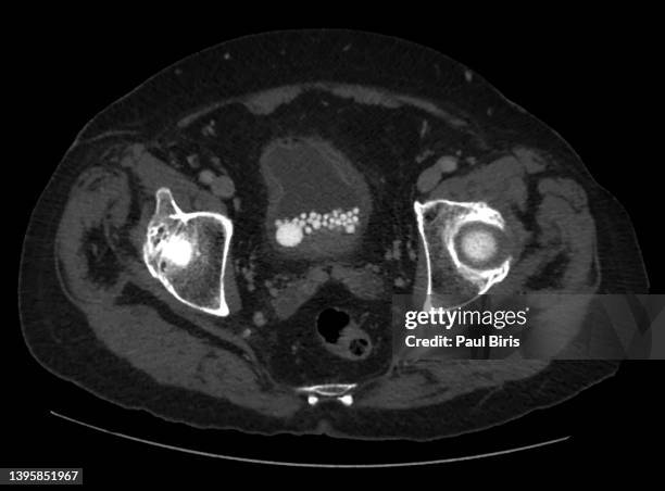 urinary  bladder stones seen on axial ct scan - carcinoma stock pictures, royalty-free photos & images