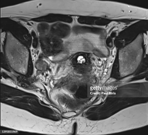 endometriosis involving the  right sciatic nerve seen on magnetic resonance imaginig (mri) - fallopian tube bildbanksfoton och bilder