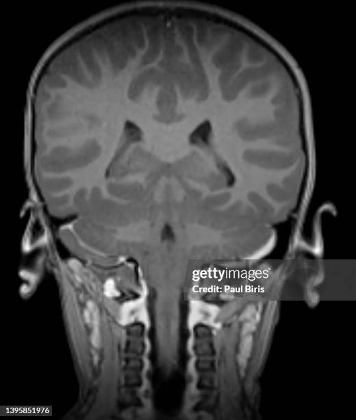 generalised cerebral and cerebellar oedema seen on mri, pediatric diffuse cerebral edema seen on coronal t1 postcontrast view - cerebrum stock-fotos und bilder