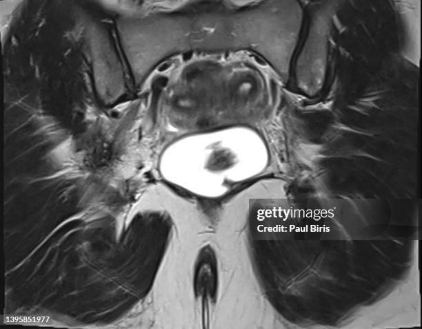 bicornuate uterus (double uterus) seen on mri  t2 image - fibroids 個照片及圖片檔