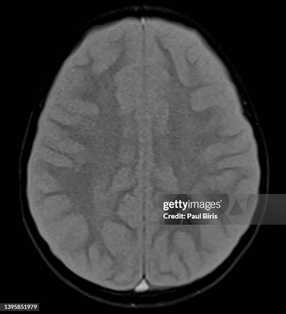 Cerebral Edema Photos and Premium High Res Pictures Getty Images
