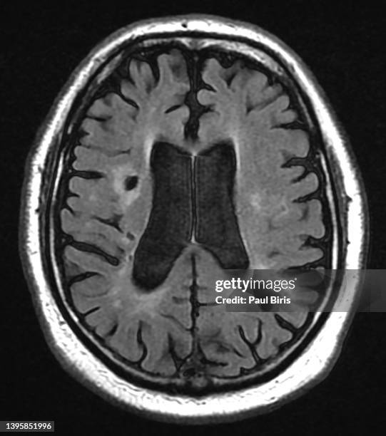 cerebral small vessel disease (svd) seen on mri flair image, axial view - petechiae stockfoto's en -beelden