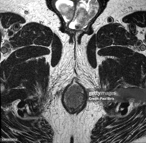 cancer of the anal canal , mri axial t2 smal fov view - mri abdomen stock pictures, royalty-free photos & images