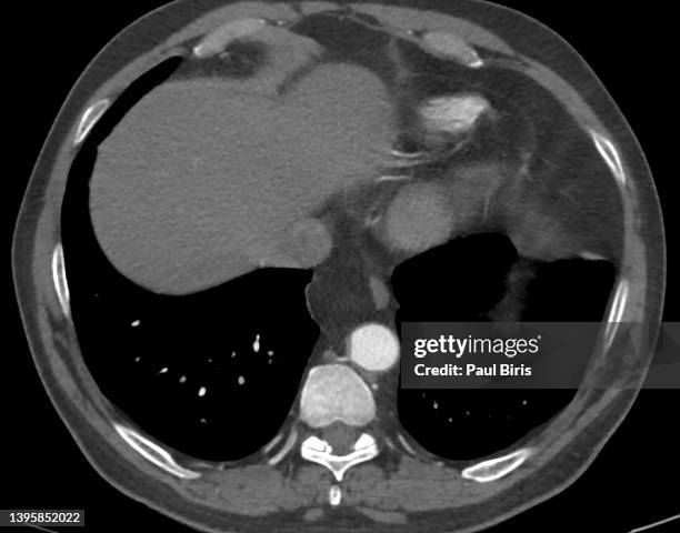 omental herniation through the esophageal hiatus seen on ct image - hernia de hiato fotografías e imágenes de stock