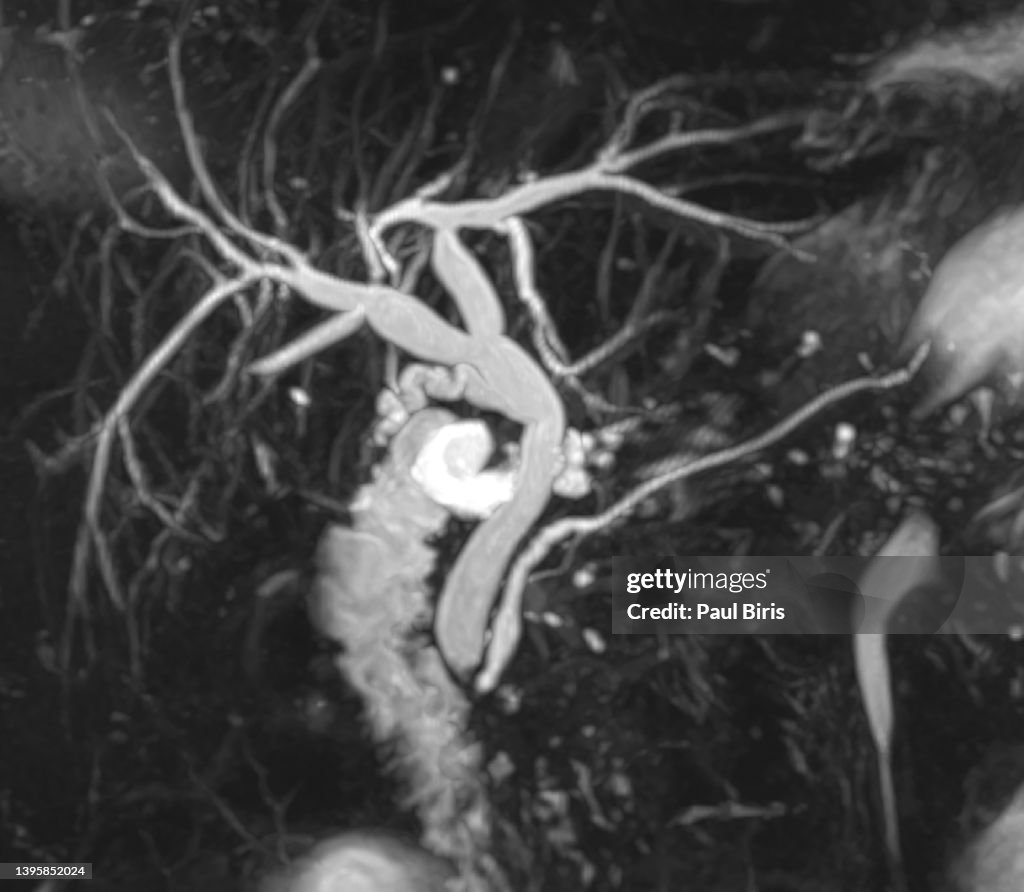 Mrcp View Mrcp 3d Mip Image Showing Visualize The Biliary And Pancreatic Ducts ...
