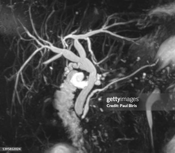 mrcp (mr cholangiopancreatography), 3d mip image showing visualize the biliary and pancreatic ducts - common bile duct stock pictures, royalty-free photos & images