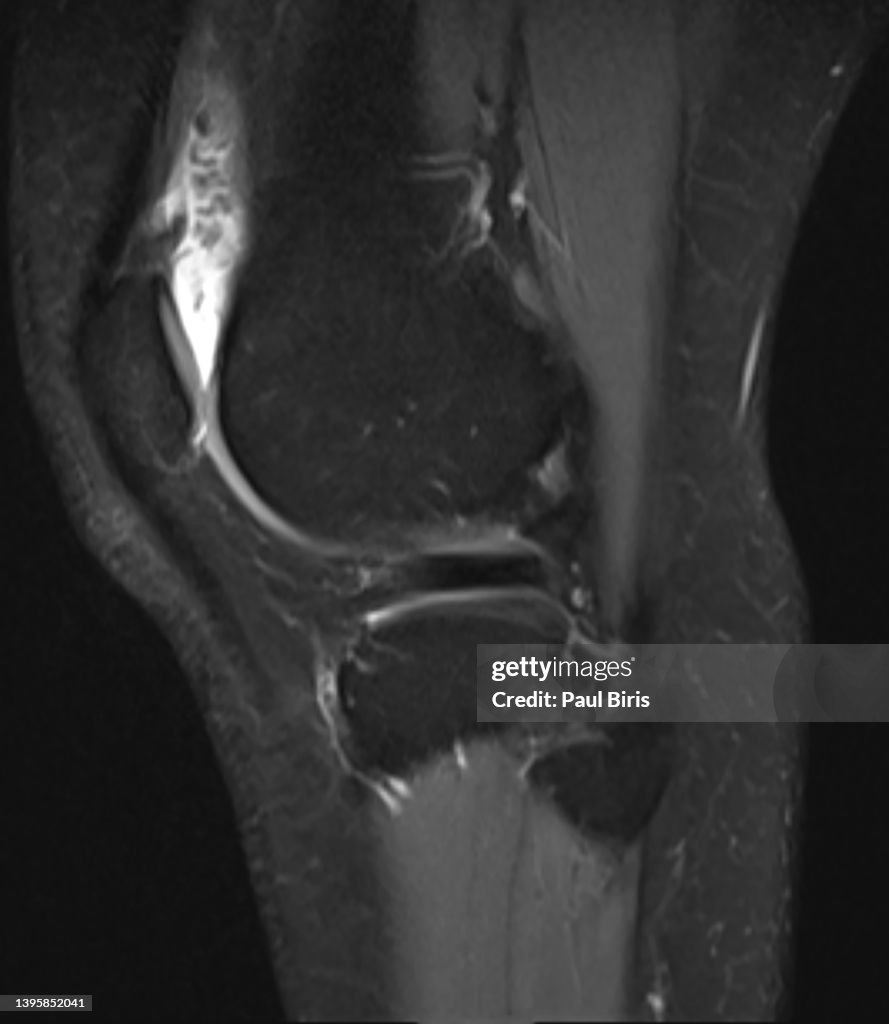 Pigmented villonodular synovitis - knee, MRI image, sagittal view T2 FatSat