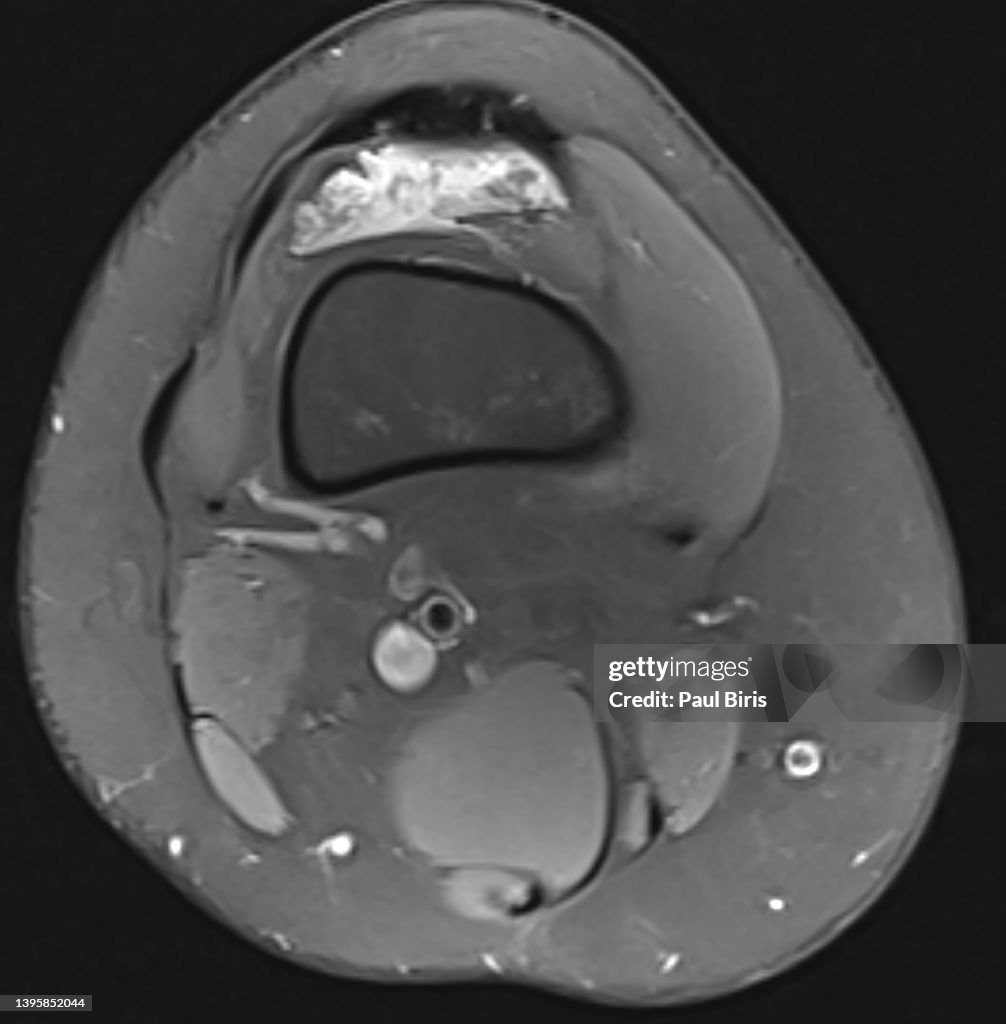 Pigmented villonodular synovitis - knee, MRI image, axial view T2 FatSat