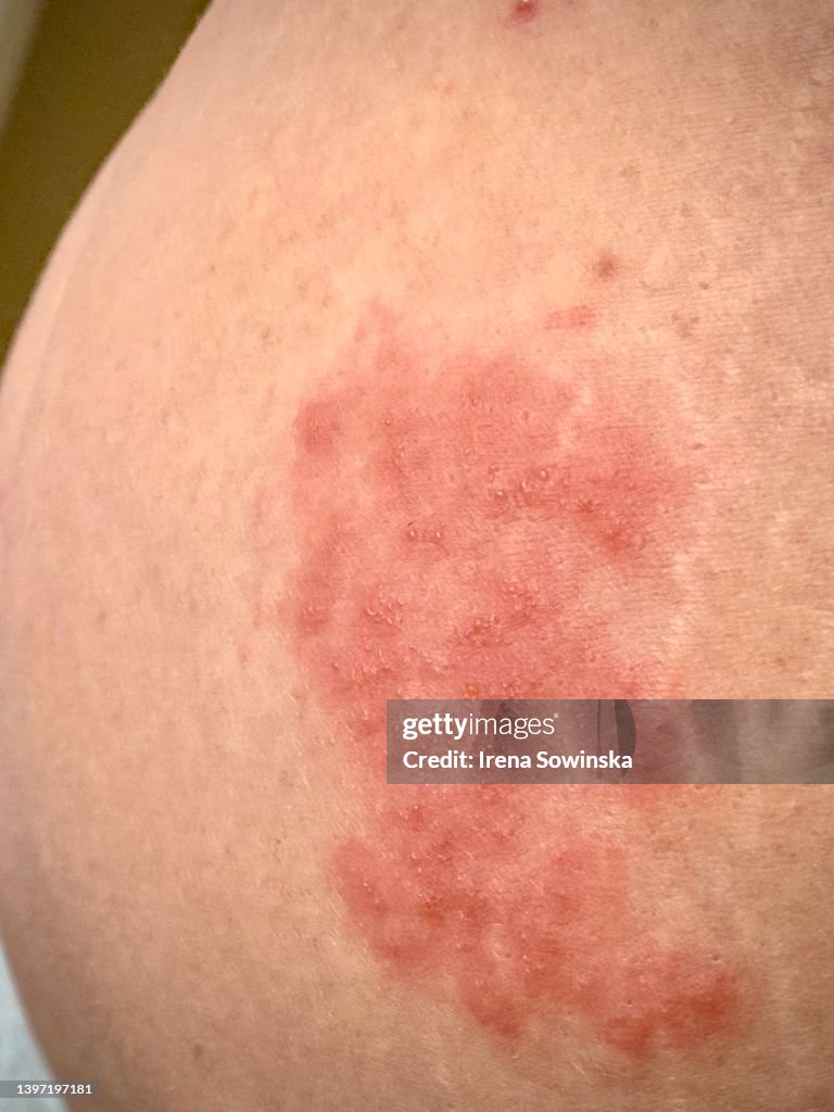 Herpes Zoster
