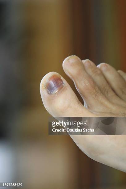 damaged toenail that is discolored - bruised finger stock-fotos und bilder