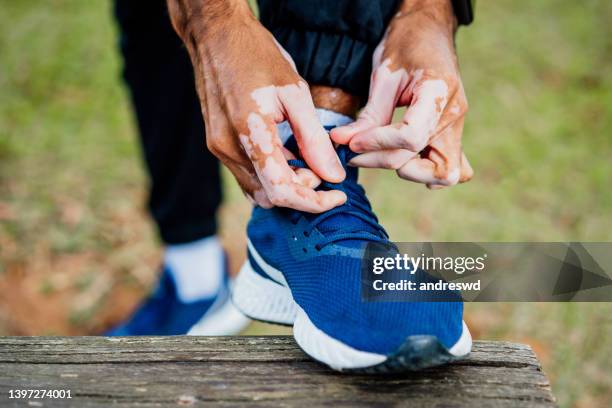 man with vitiligo tying the shoelace - systemic lupus erythematosus stock pictures, royalty-free photos & images