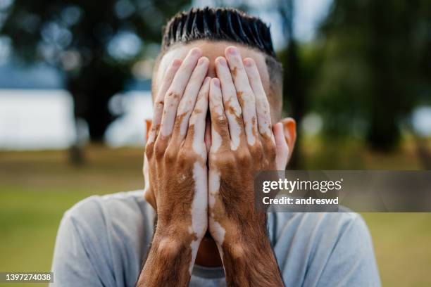 man with vitiligo hiding the face - systemic lupus erythematosus stock pictures, royalty-free photos & images