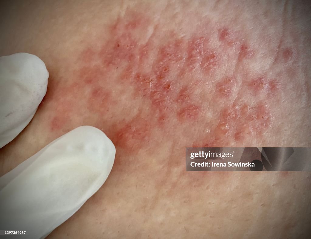 Diffuse Zoster Herpes Zoster High-Res Stock Photo - Getty Images