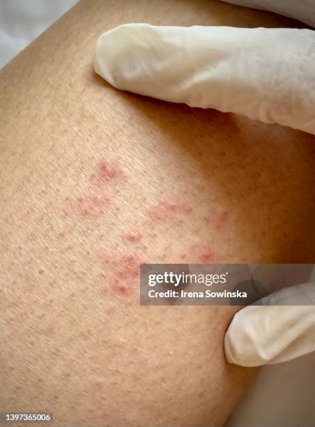 Zozster Rash Herpes Zoster Rash Photos and Premium High Res Pictures - Getty Images