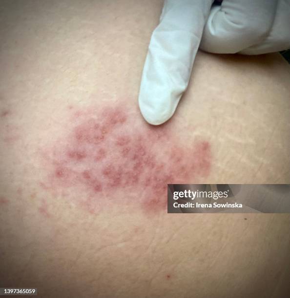 herpes zoster - blister stockfoto's en -beelden