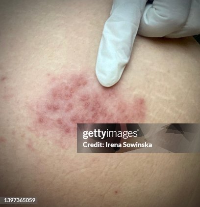 Herpes Zoster Herpes Zoster