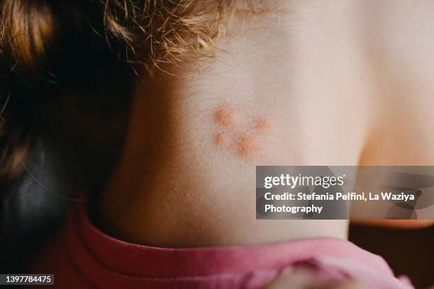 insect bites on child's neck. - spider fotografías e imágenes de stock