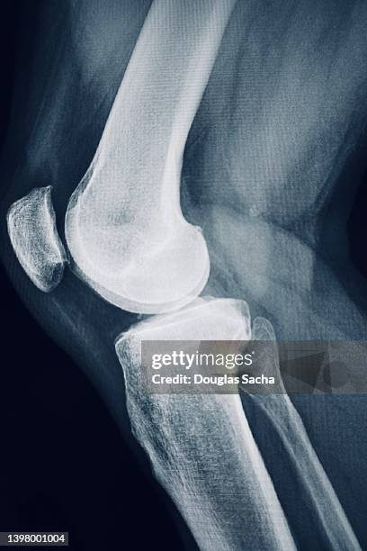 human knee joint - knochenbruch stock-fotos und bilder
