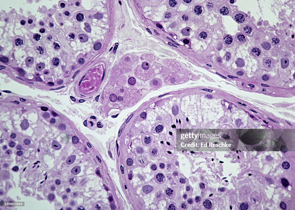 SEMINIFEROUS TUBULES, TESTIS (Human), Spermatogenesis, interstitial cells, 100X. Shows: interstitial cells (cells of Leydig), blood vessel with RBCs, chromosomes (black). Interstitial cells produce testosterone.