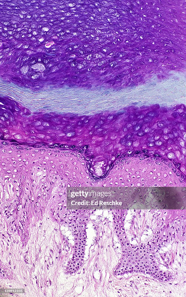Five Epidermal Layers (or strata) in Thick Skin, Human. Magnification x50. From bottom to top: stratum basale, stratum spinosum, stratum granulosum, stratum lucidum and stratum corneum. Also shows the dermis below.