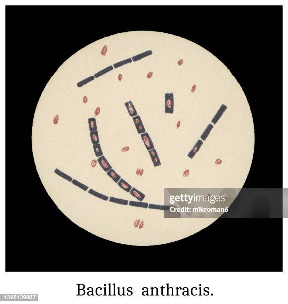 old chromolithograph illustration of magnification of bacteria bacillus anthracis - cutaneous anthrax photos et images de collection