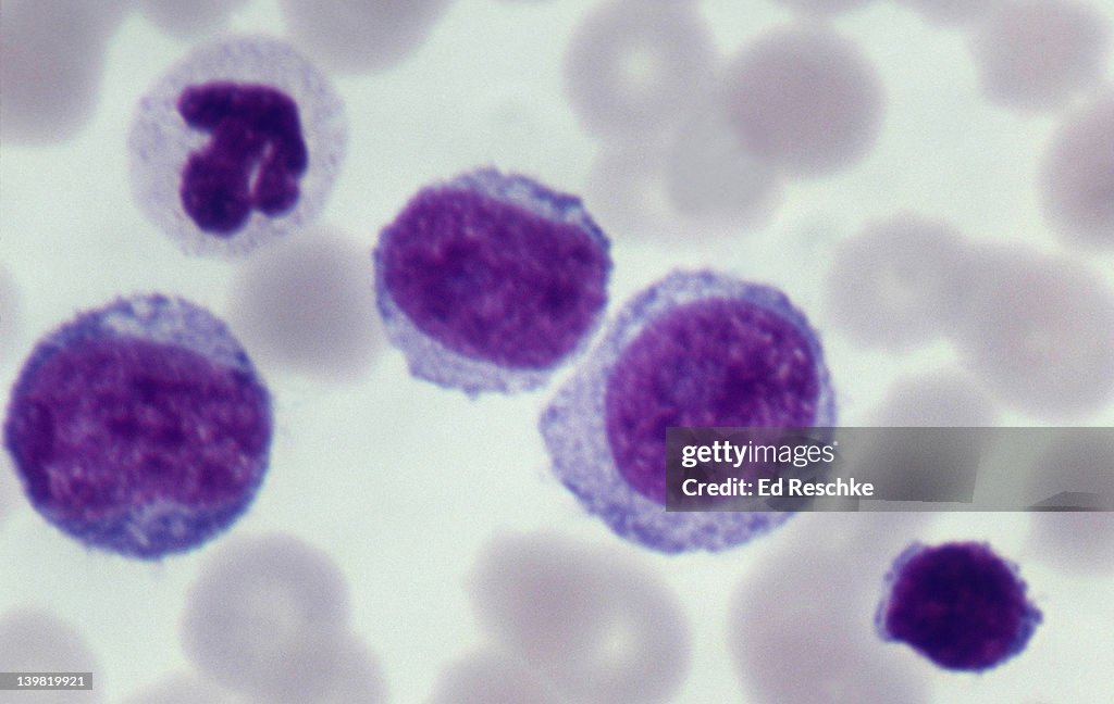 Acute lymphatic leukemia (All), 500X at 35mm. 3 large similar cells are Lymphoblasts (immature lymphocytes). The cell in the lower right is a lymphocyte. Acute leukemia is a malignant disease of blood-forming tissues characterized by uncontrolled pr