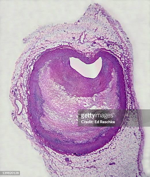 atherosclerosis. cross section of coronary artery, human, 4x at 35mm. has large amount of plaque, & greatly reduced lumen. large amounts of lipids, calcium, chlolesterol & fibrous connective tissue are deposited in the wall. - heart cross section stock pictures, royalty-free photos & images