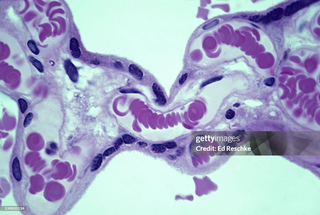 Capillaries & red blood cells of human placenta, 250X at 35mm. Shows the capillaries in the placenta with red blood cells in single file & the capillary endothelium. On the outside of the placental tissue are blood pools with maternal blood cells. M