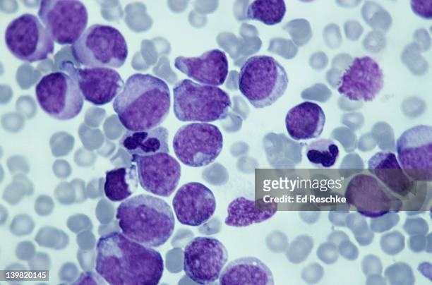 leukemia; myeloid, 250x at 35mm. this type of leukemia has its origin in the bone marrow (myeloid tissue). it involves a malignant proliferation of immature white blood cells. this action can crowd out production of rbc s and platelets leading to an - biological cell stock pictures, royalty-free photos & images