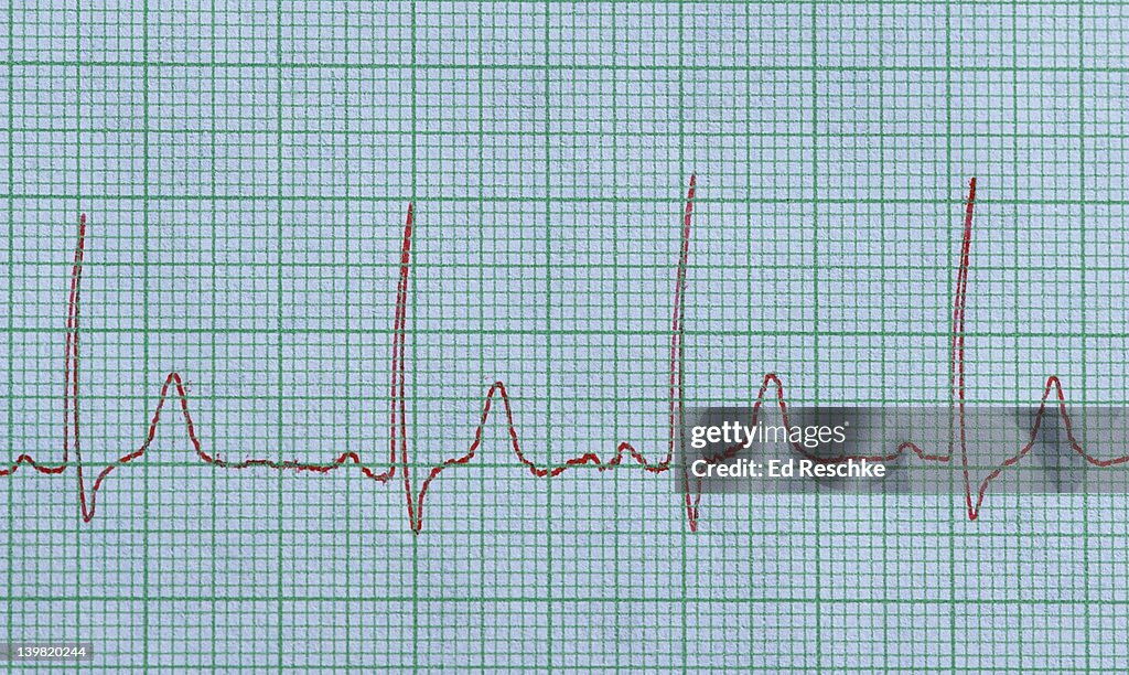 Normal Electrocardiogram Shows Four Cardiac Cycles The Smallest Squares ...