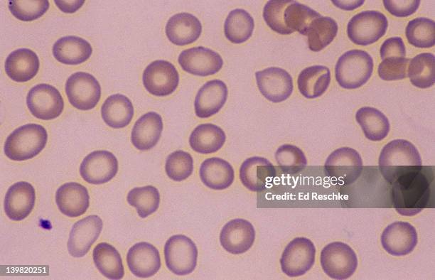 iron deficiency anemia. hypochromic red blood cells, 400x at 35mm. human blood smear. the erythrocytes (rbcs) have an abnormally large central pallor (hypochromic cells) because of a lesser concentration of hemoglobin. microcytic - eisenmangel stock-fotos und bilder