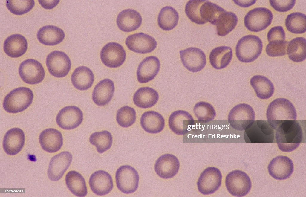 Iron deficiency anemia. Hypochromic red blood cells, 400X at 35mm. Human blood smear. The erythrocytes (RBCs) have an abnormally large central pallor (hypochromic cells) because of a lesser concentration of hemoglobin. Microcytic