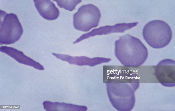 sickle cell anemia. distorted or sickled cells, 640x at 35mm. shows 3 severely distorted or sickled cells. sickled cells may block small blood vessels. hereditary disease that produces an abnormal hemoglobin. - sickle cell stock pictures, royalty-free photos & images