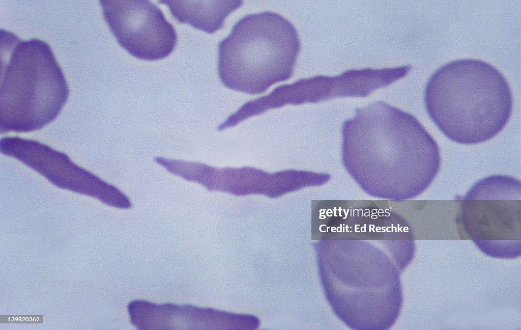 Sickle cell anemia. Distorted or sickled cells, 640X at 35mm. Shows 3 severely distorted or sickled cells. Sickled cells may block small blood vessels. Hereditary disease that produces an abnormal hemoglobin.