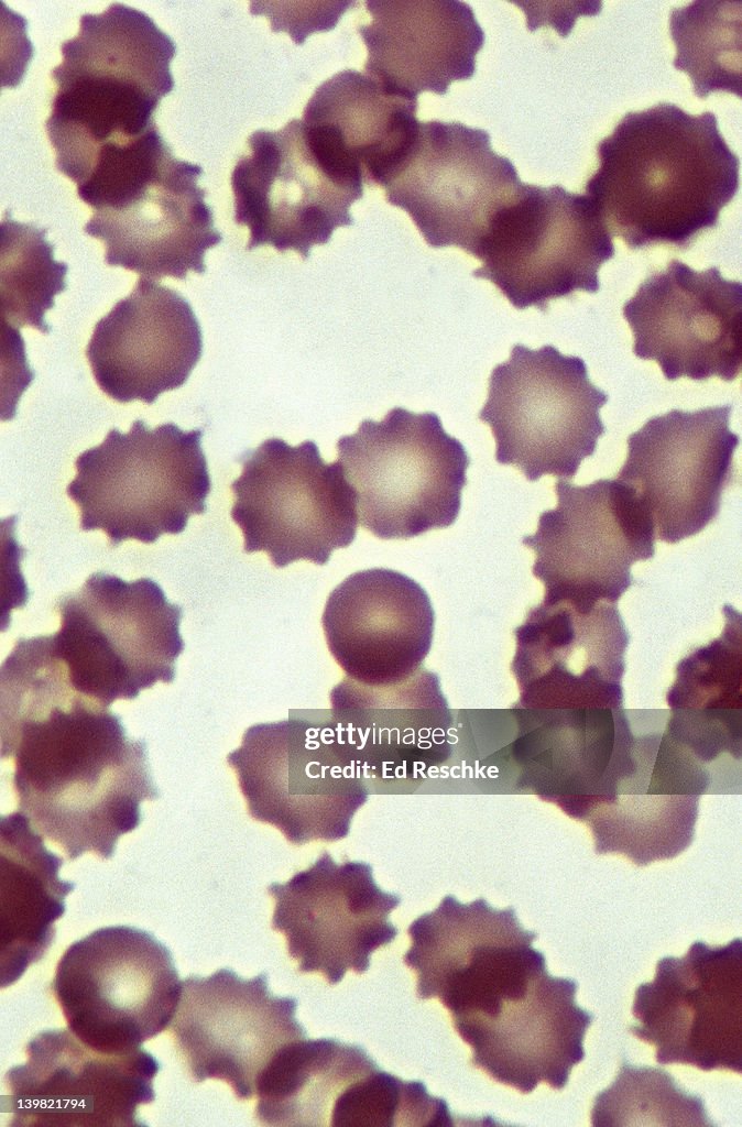Crenated red blood cell (erythrocytes) hypertonic solution, 500X at 35mm. The Red Blood Cells have lost water to a hypertonic salt solution (5%). The red cells have shrunk giving their margins a very irregular appearance (crenation).