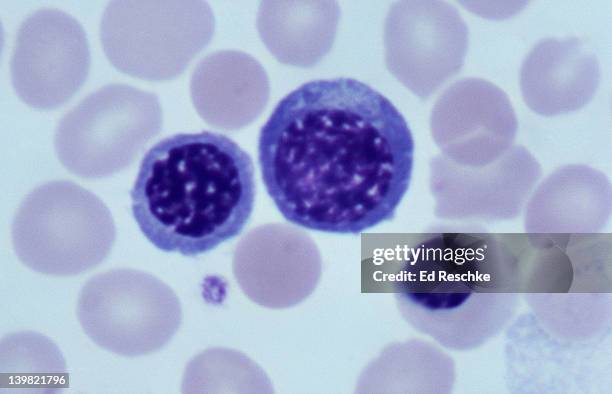 erythroblastosis fetalis, rh incompatability, erythroblasts & nomoblast, 640x at 35mm. these are nucleated (immature) red blood cells. there are two erythroblasts (larger cells), and one normoblast (smaller, nucleated cell). - anemia hemolítica fotografías e imágenes de stock