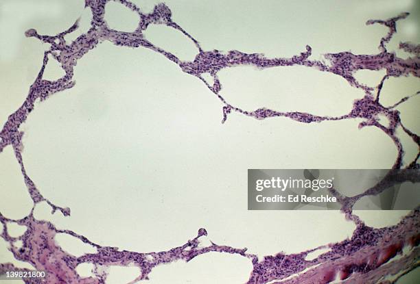 emphysema, lung disease. human lung tissue, 25x at 35mm. emphysema destroys the alveolar walls & elastic tissue, causing loss of alveoli & surface area, and produces large air spaces in the lungs that have less capacity for gas exchange. note the la - emphysema stock pictures, royalty-free photos & images