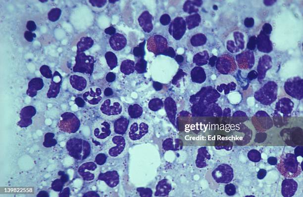 photomicrograph of human red bone marrow where eosinophils (red granular), neutrophils, and neuroblasts are formed; 250x - neutrophil stock pictures, royalty-free photos & images